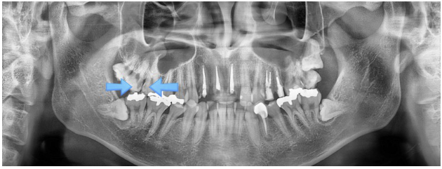 인덕원 신경치료3