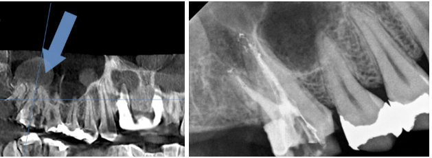 인덕원 신경치료6