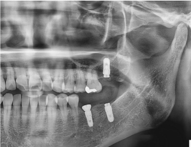 인덕원 임플란트 이후에 볼과 혀를 자주 씹어요 4 인덕원 임플란트 03