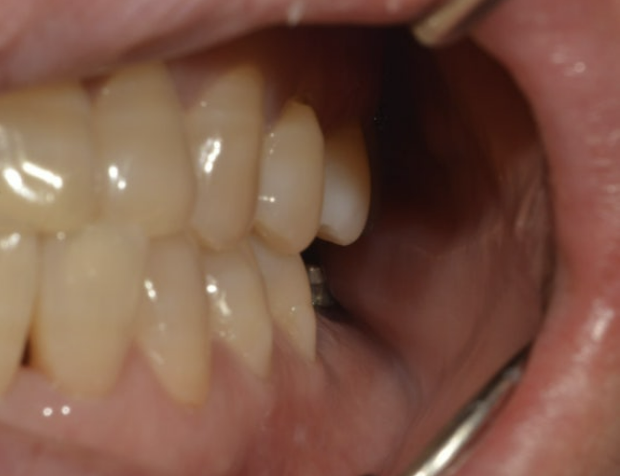 안양 믿음치과 - 인덕원 임플란트 이후에 볼과 혀를 자주 씹어요