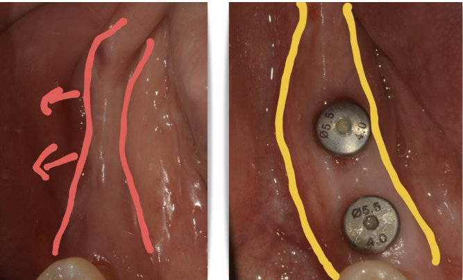 인덕원 임플란트 뼈이식 04 1