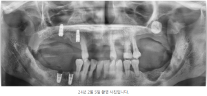 안양 믿음치과 - 인덕원 임플란트 뼈이식 05 2