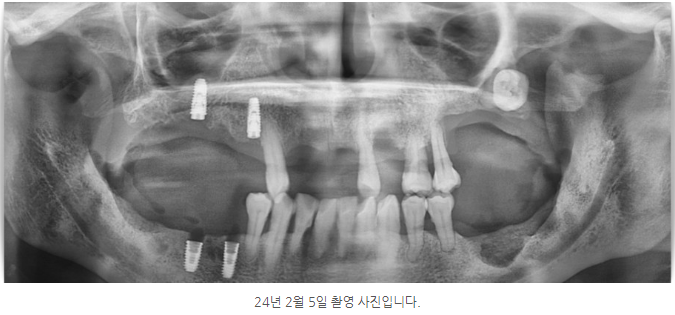 안양 믿음치과 - 인덕원 임플란트 뼈이식 왜 필요한지 알아보세요