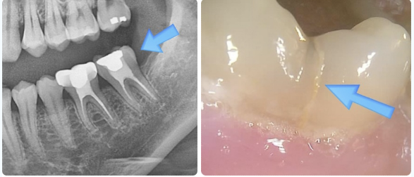 인덕원 크라운치료 1