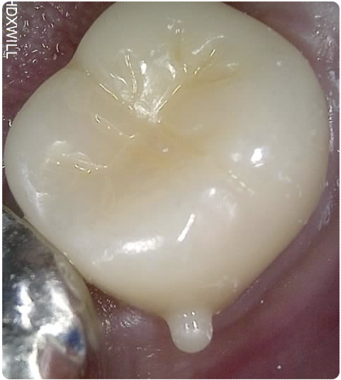 인덕원 크라운치료 2