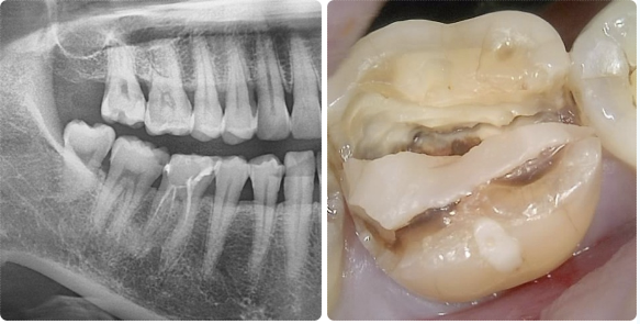 인덕원 크라운치료 3