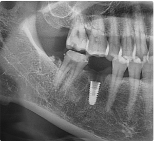 안양 믿음치과 - 인덕원 크라운치료 4  1
