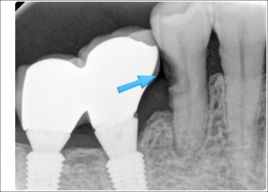 안양 믿음치과 - 신경치료4