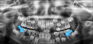 안양 믿음치과 - 유아충치2