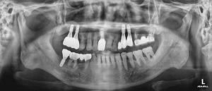 안양 믿음치과 - 임플란트1