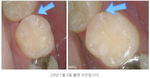 안양 믿음치과 - 믿음인레이4