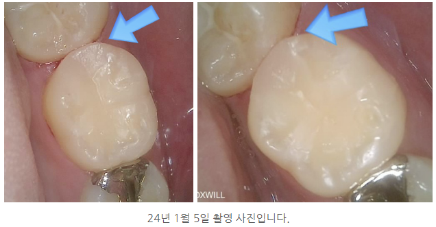 안양 믿음치과 - 인덕원 인레이치료 잘못되었을 때 어떤 문제가 생길 수 있을까요?