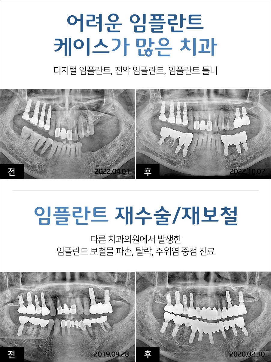 포일동임플란트10